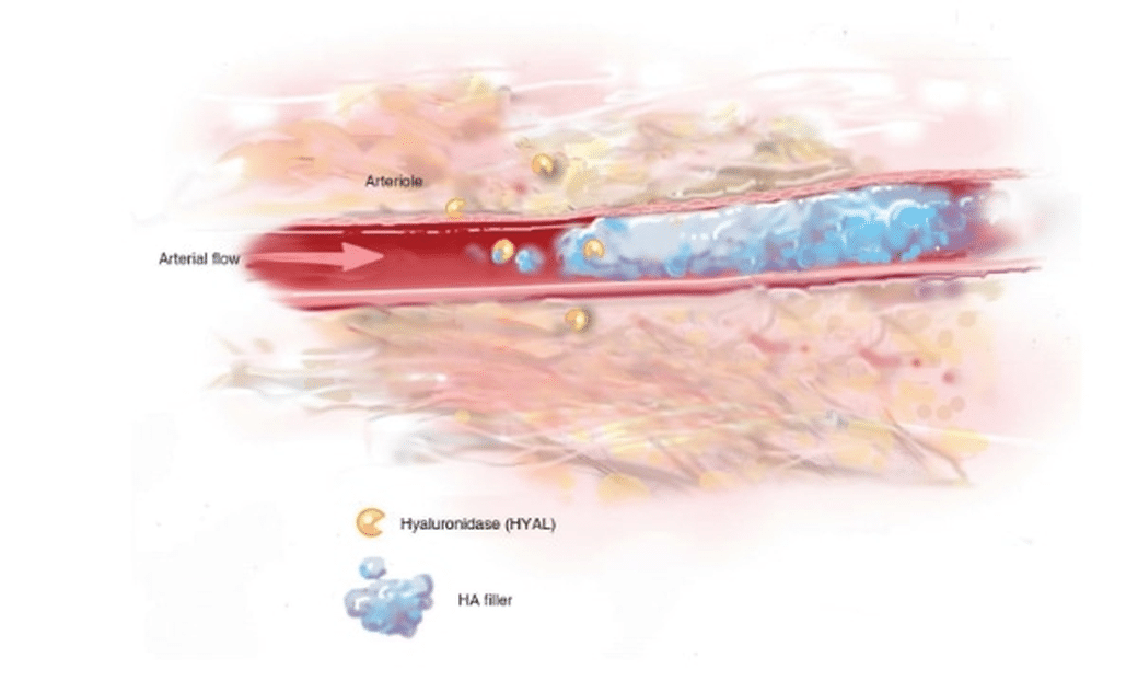 Hyaluronidase