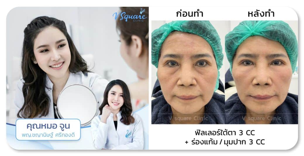 รีวิวฉีดฟิลเลอร์ใต้ตา โดย หมอจูน