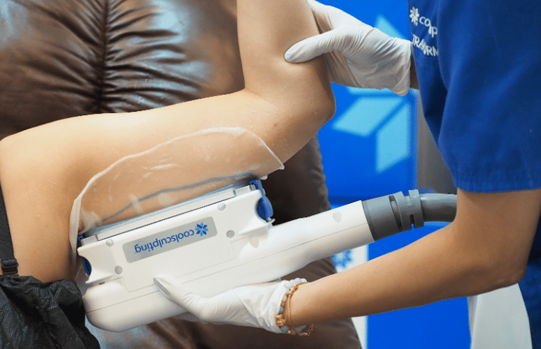 Coolsculpting สลายไขมันต้นแขน