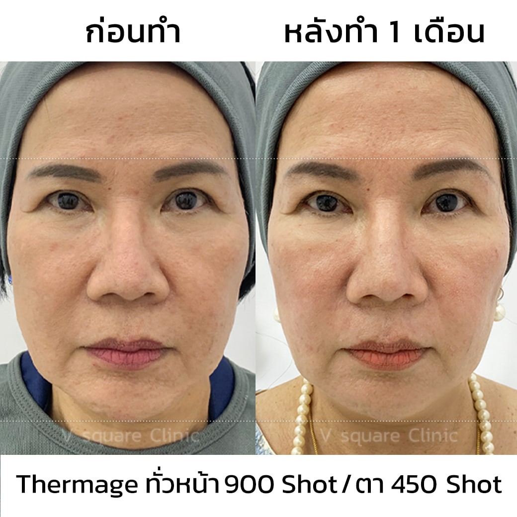 รีวิว Thermage