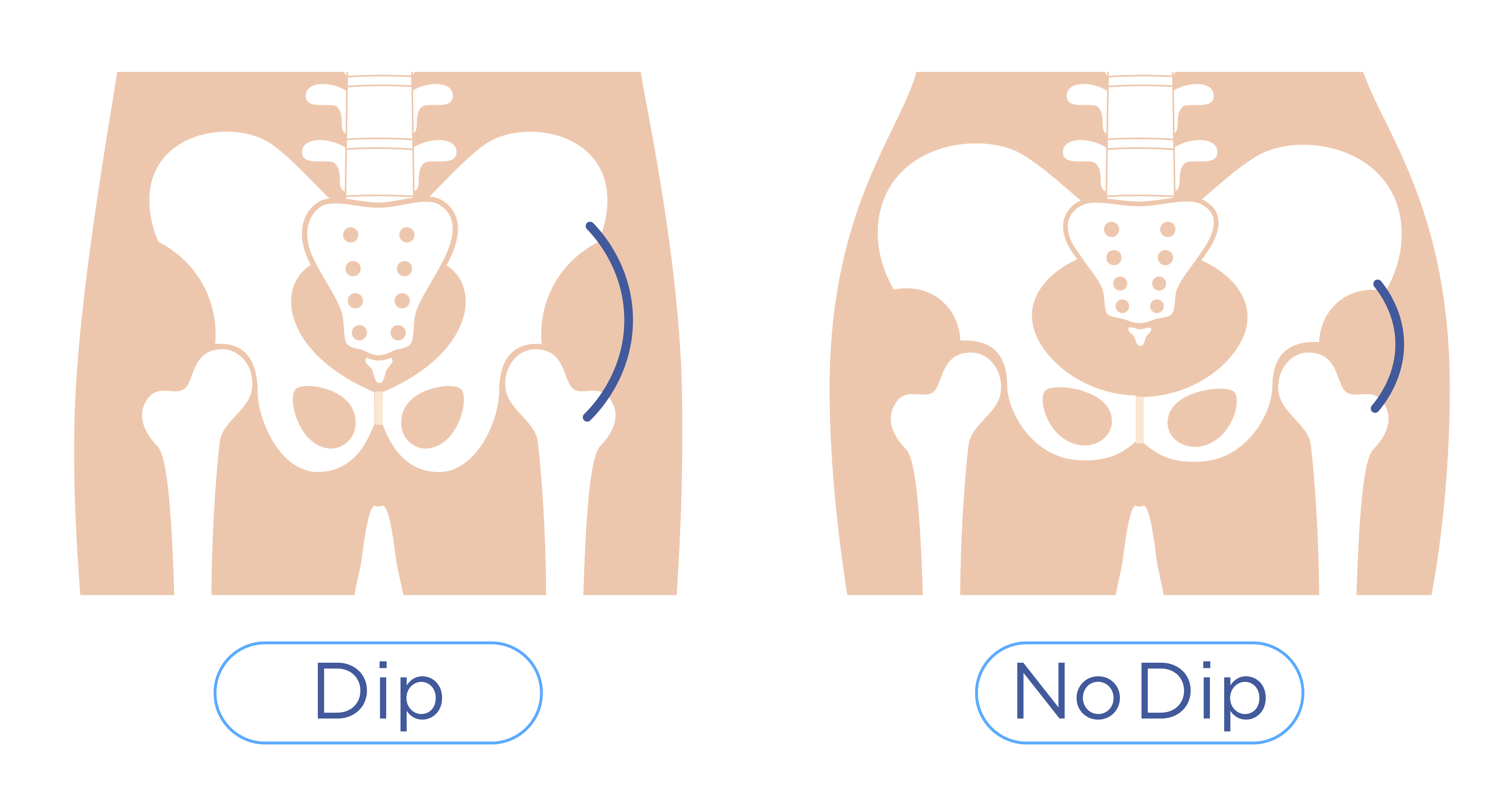 ลักษณะ Hip Dip