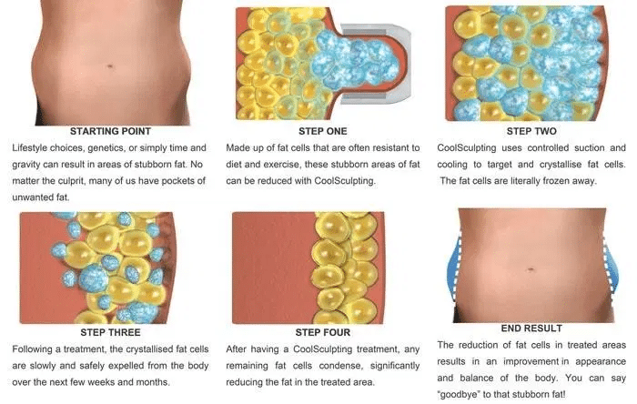 การทำงาน Coolsculpting