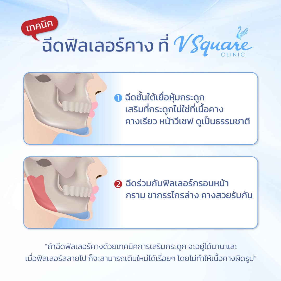 เทคนิคฉีดฟิลเลอร์คาง