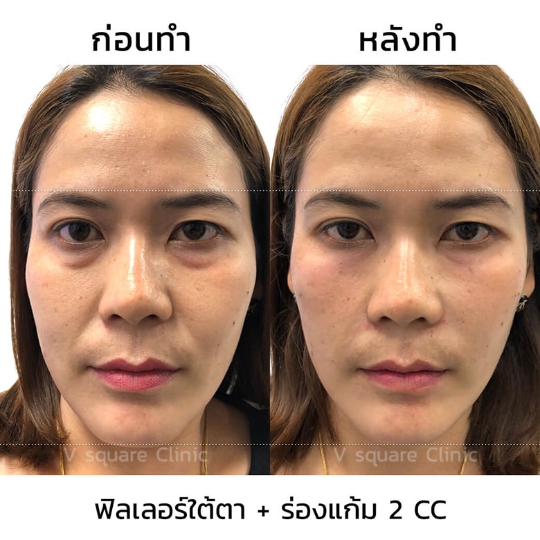 รีวิวฉีดฟิลเลอร์แก้ไขตาโหล