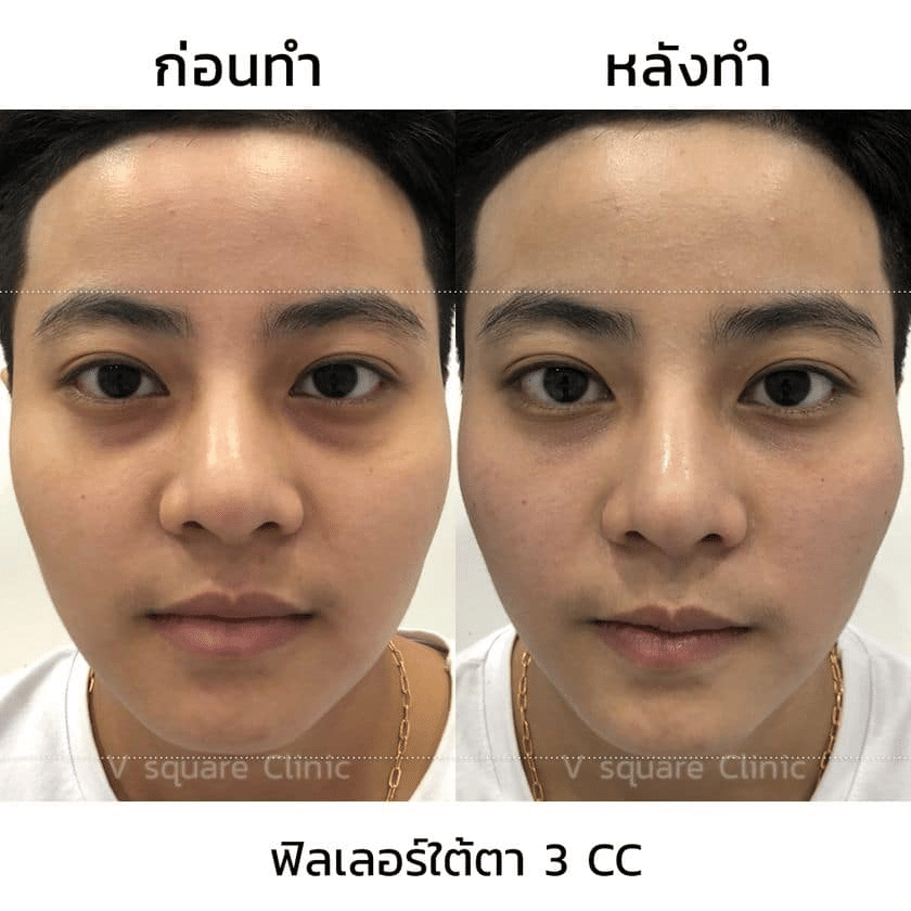 รีวิวฉีดฟิลเลอร์แก้ไขตาโหล