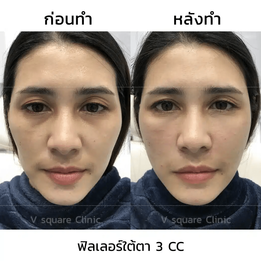 รีวิวฉีดฟิลเลอร์แก้ไขตาโหล