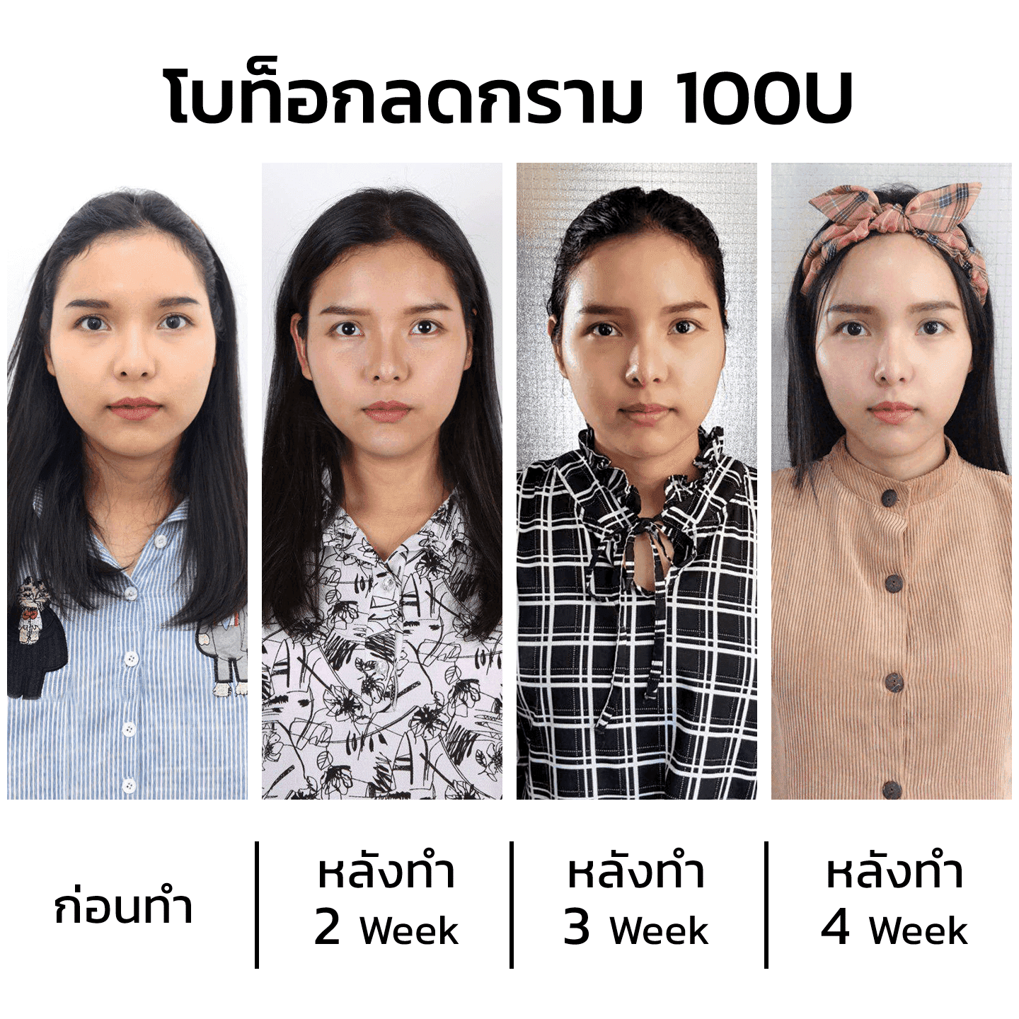 รีวิวฉีดโบท็อก