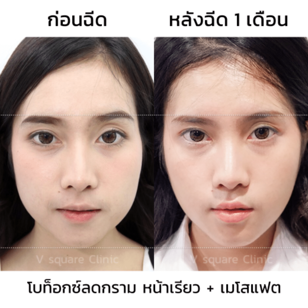 รีวิว ฉีดโบท็อก