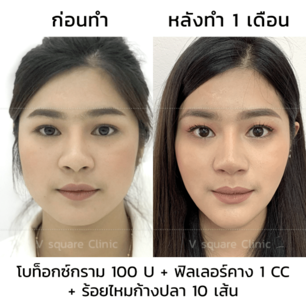 รีวิวฉีดโบท็อก