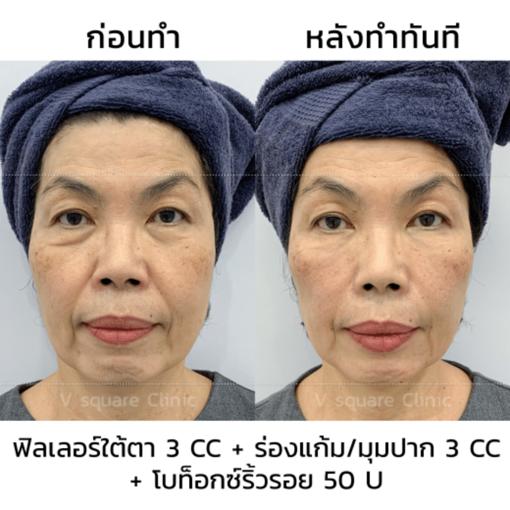 รีวิวฉีดโบท็อก