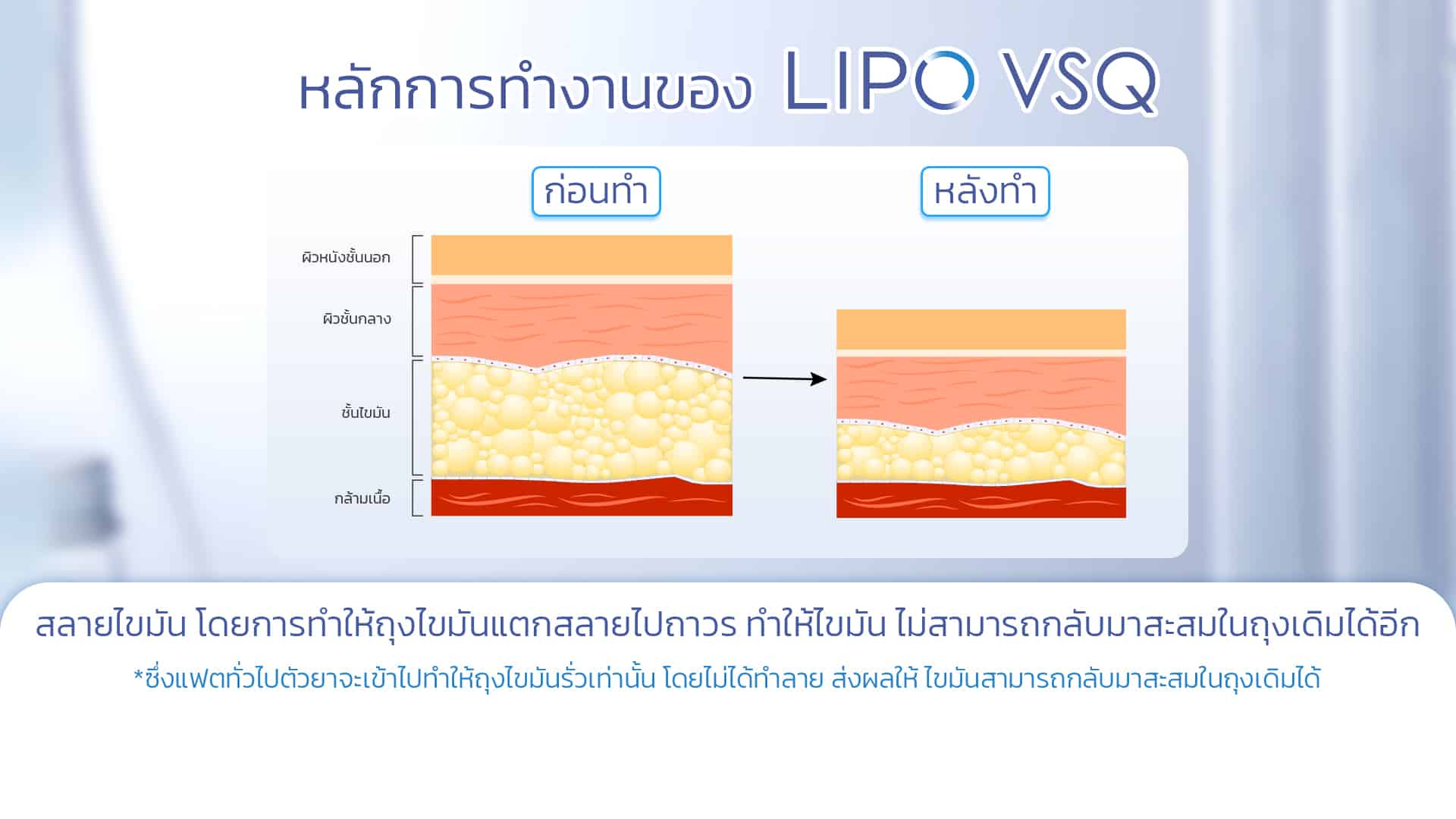 กระบวนการทำงานของ Lipo VSQ