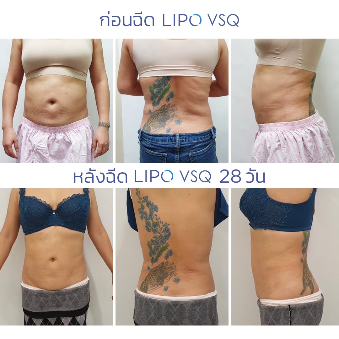 รีวิว Lipo VSQ ผลลัพธ์จากผู้ใช้จริง