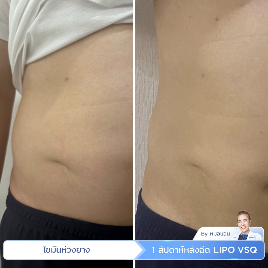 รีวิว Lipo VSQ ลดไขมันห่วงยาง