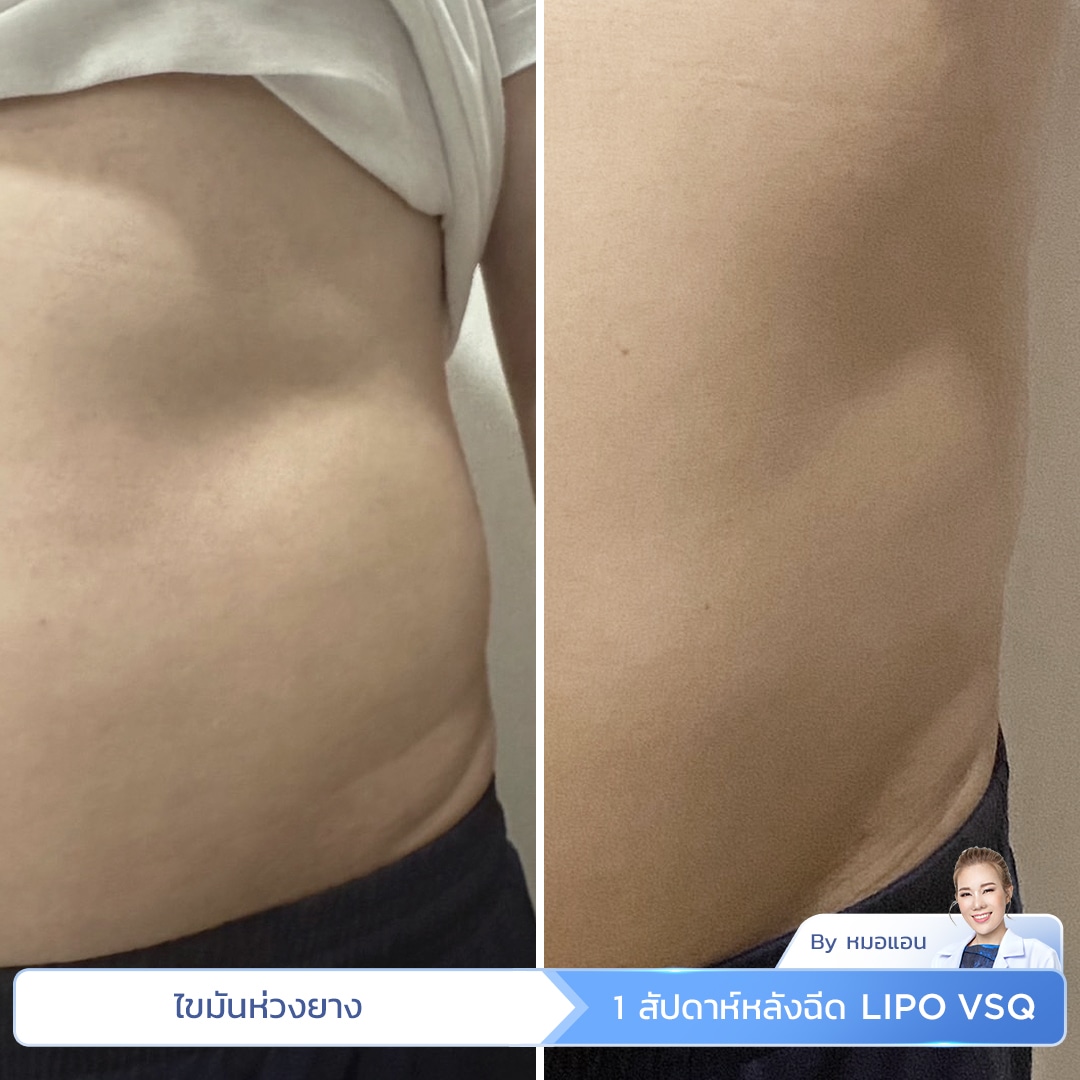 รีวิว Lipo VSQ ลดไขมันห่วงยาง