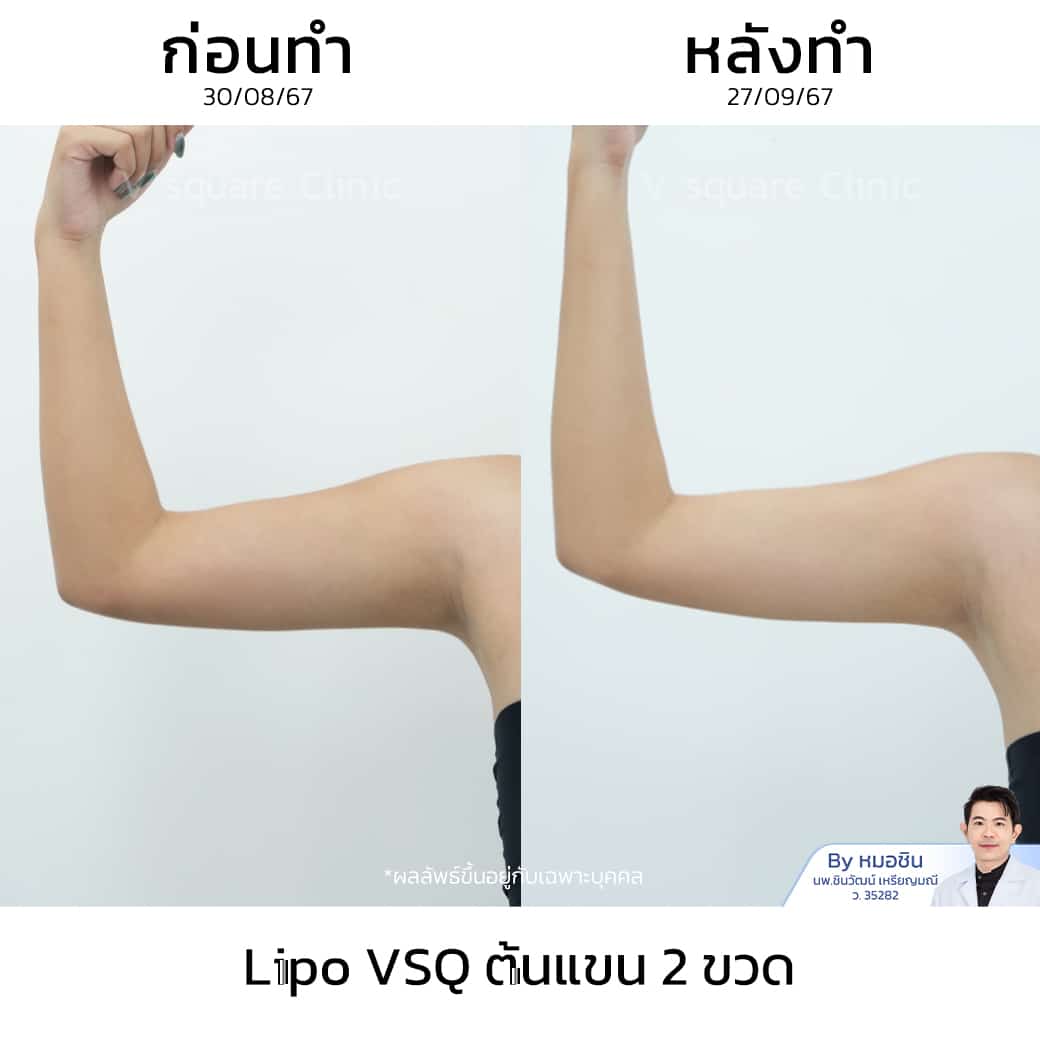 รีวิว Lipo VSQ