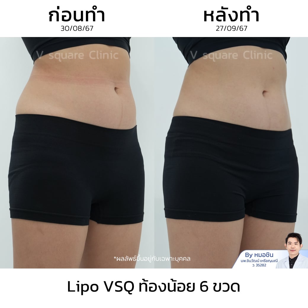 รีวิว Lipo VSQ