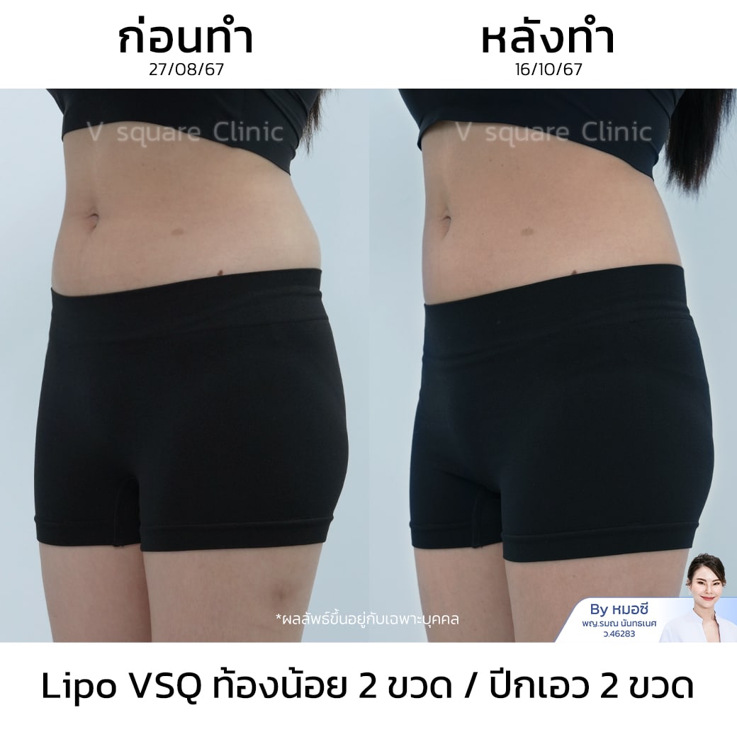 รีวิว Lipo VSQ