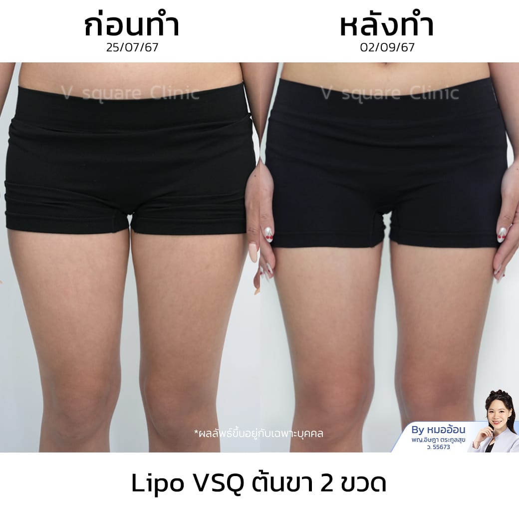 รีวิว Lipo VSQ