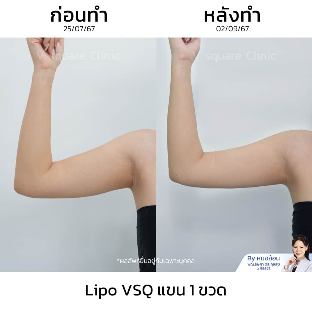 รีวิว Lipo VSQ