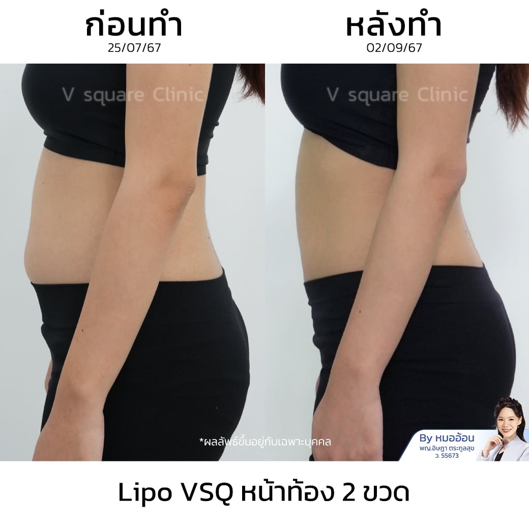 รีวิว Lipo VSQ