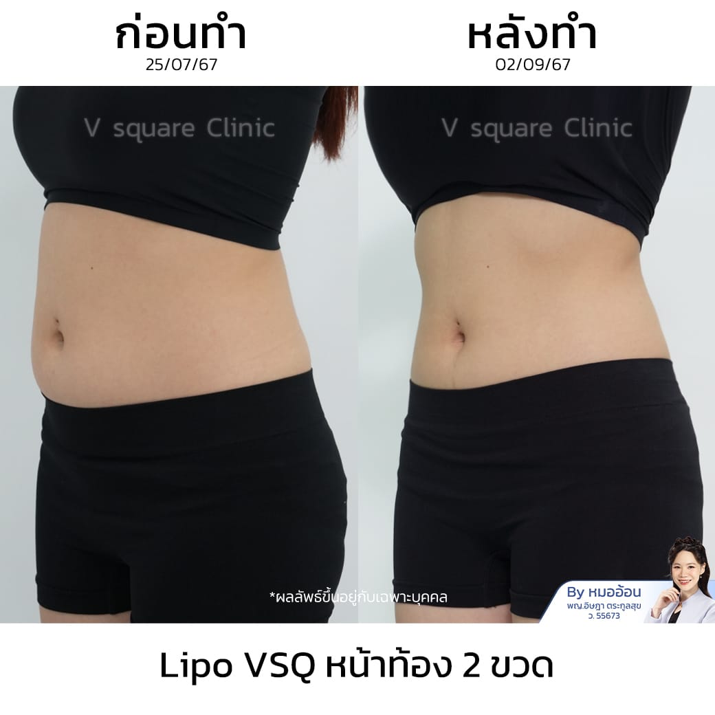 รีวิว Lipo VSQ