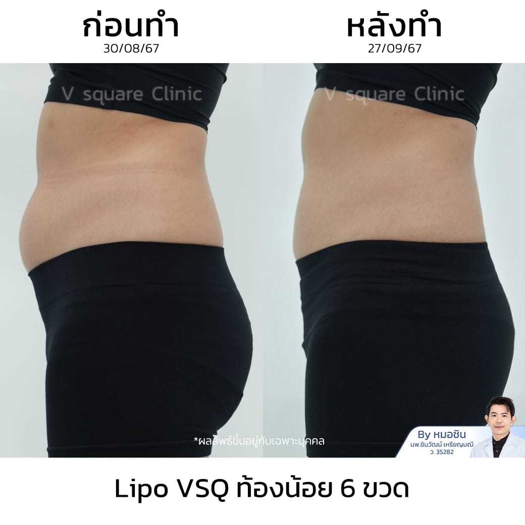 รีวิว Lipo VSQ