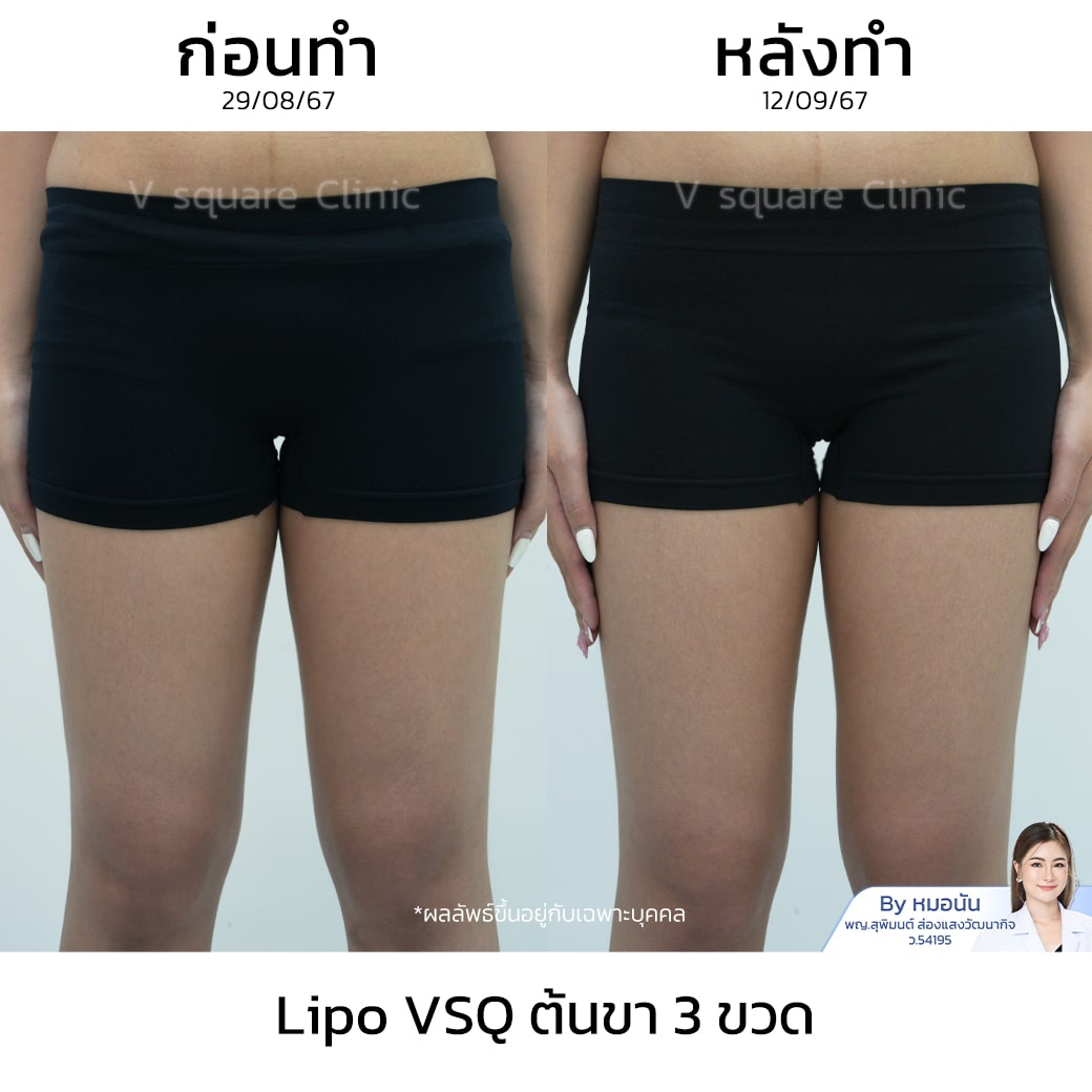 รีวิว Lipo VSQ