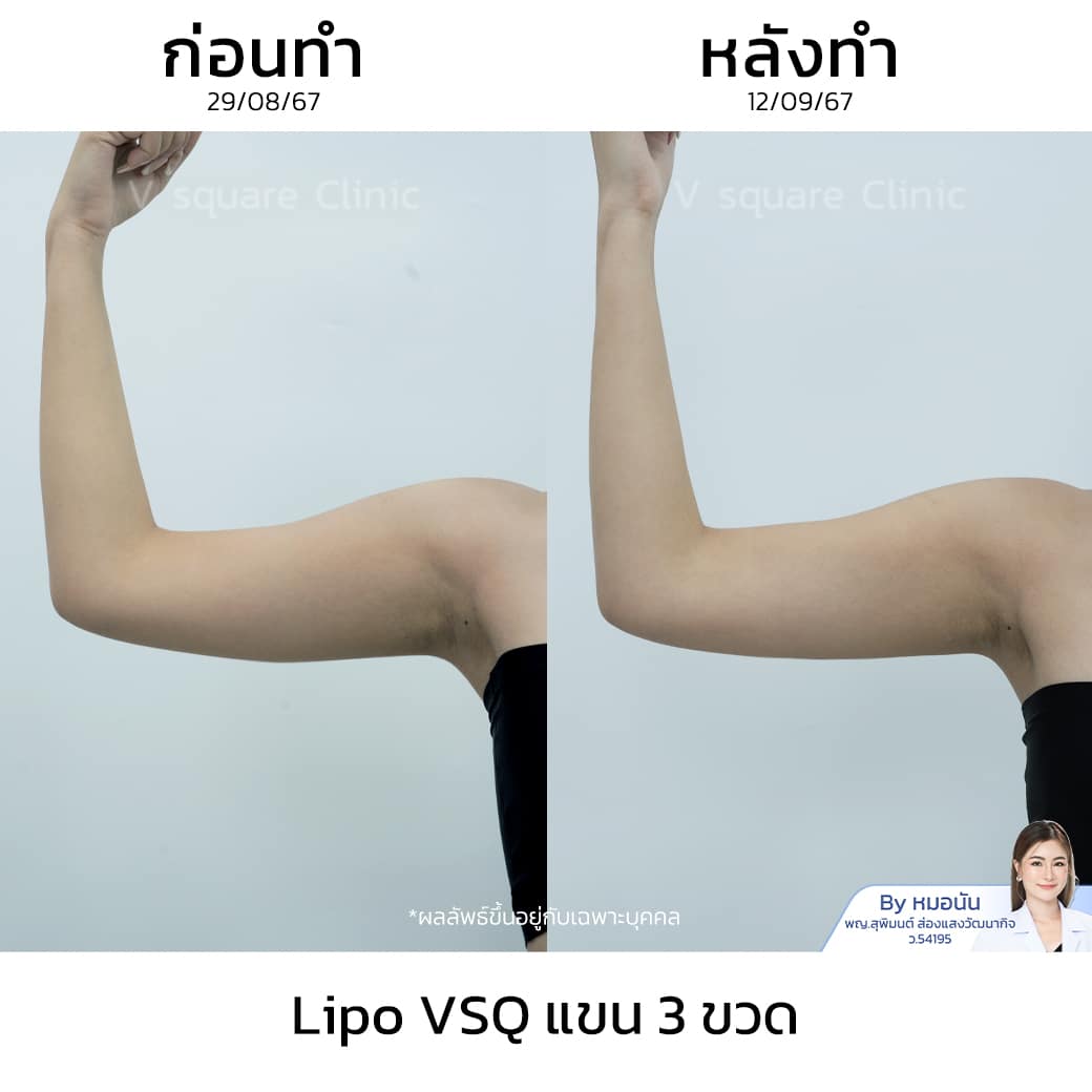 รีวิว Lipo VSQ