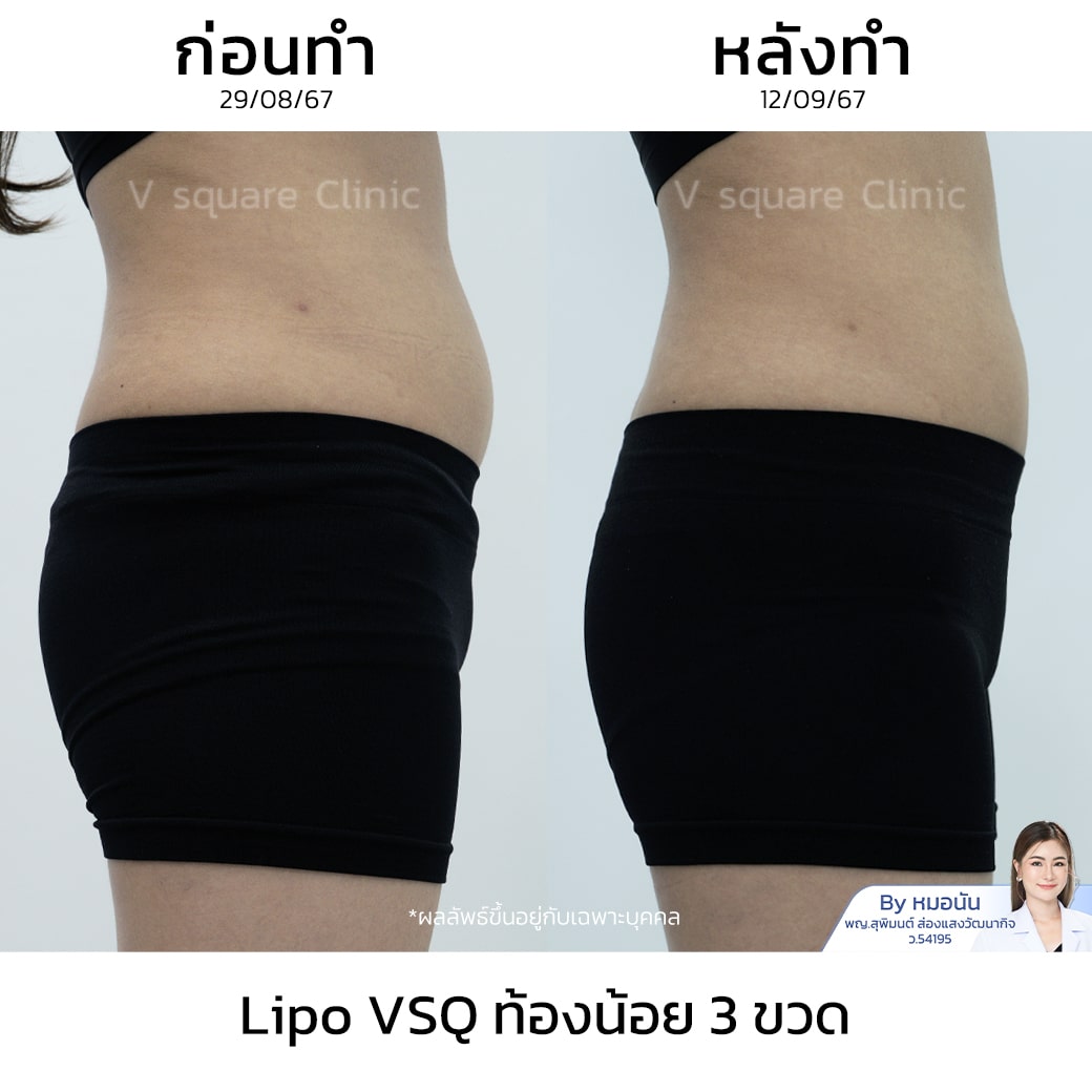 รีวิว Lipo VSQ