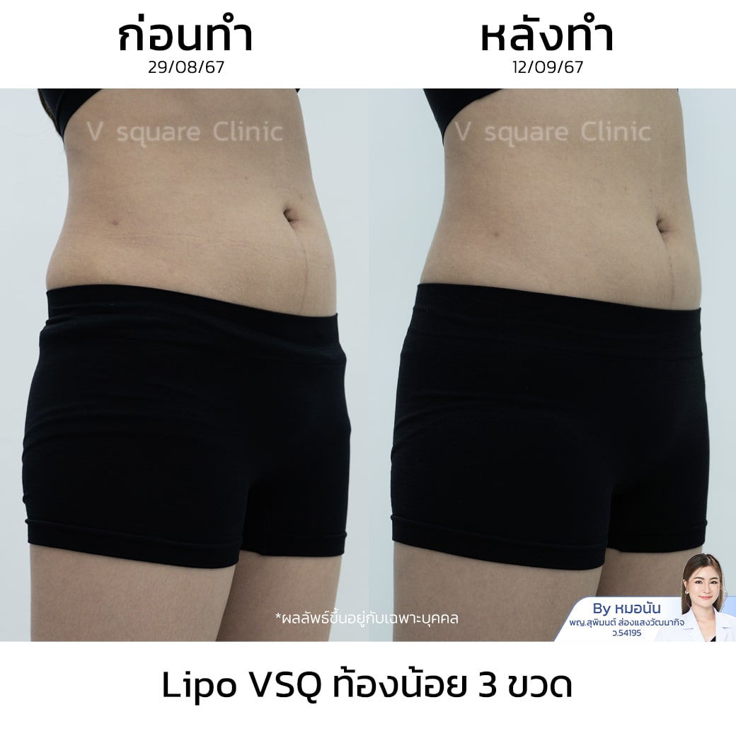 รีวิว Lipo VSQ