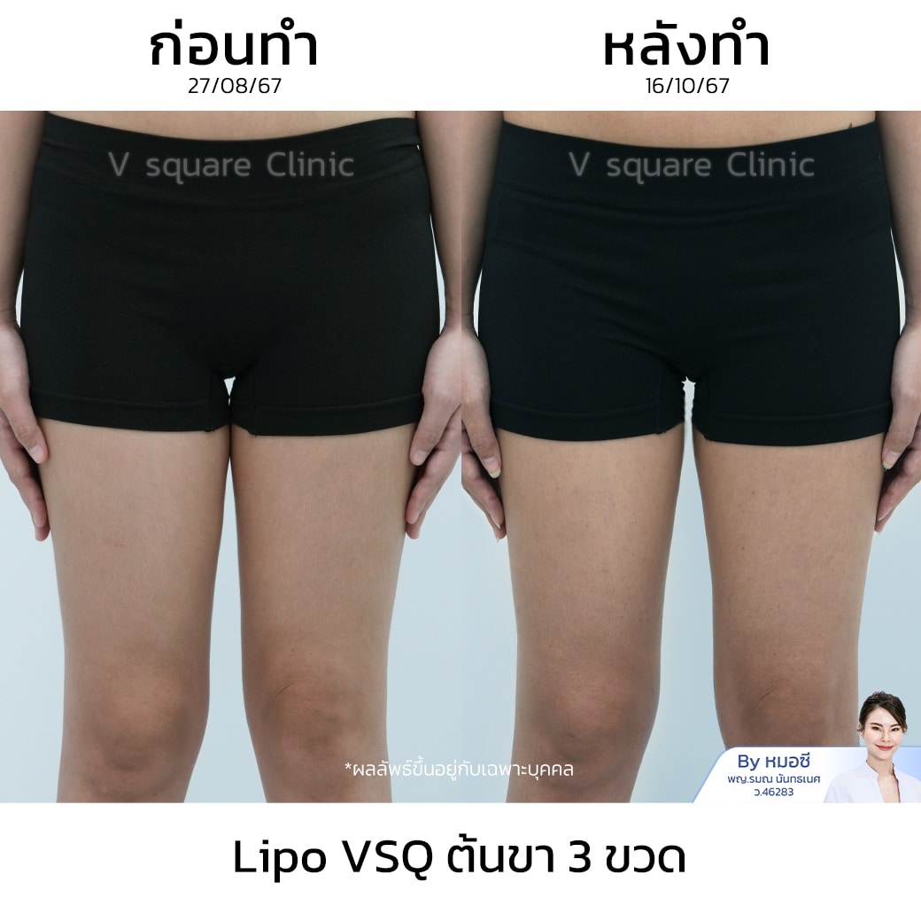 รีวิว Lipo VSQ