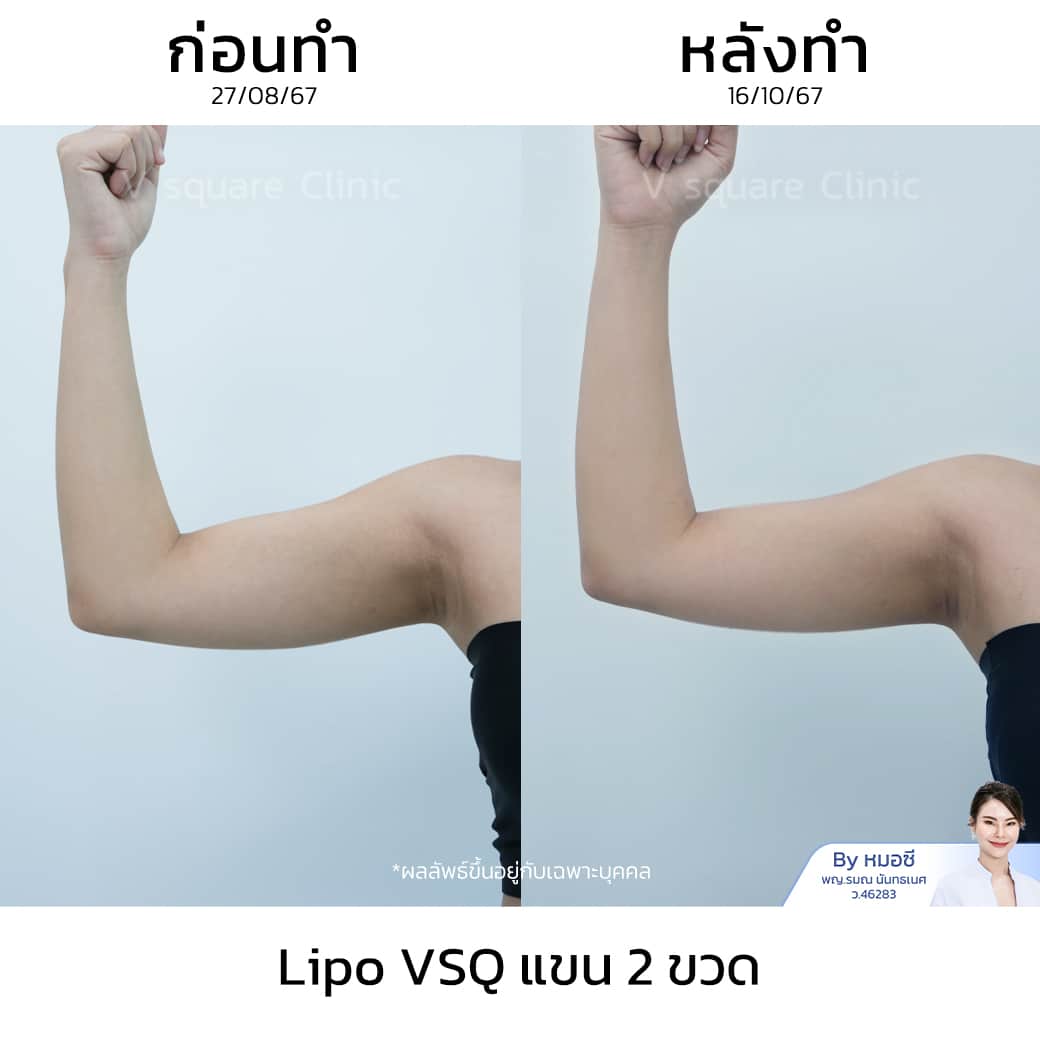 รีวิว Lipo VSQ