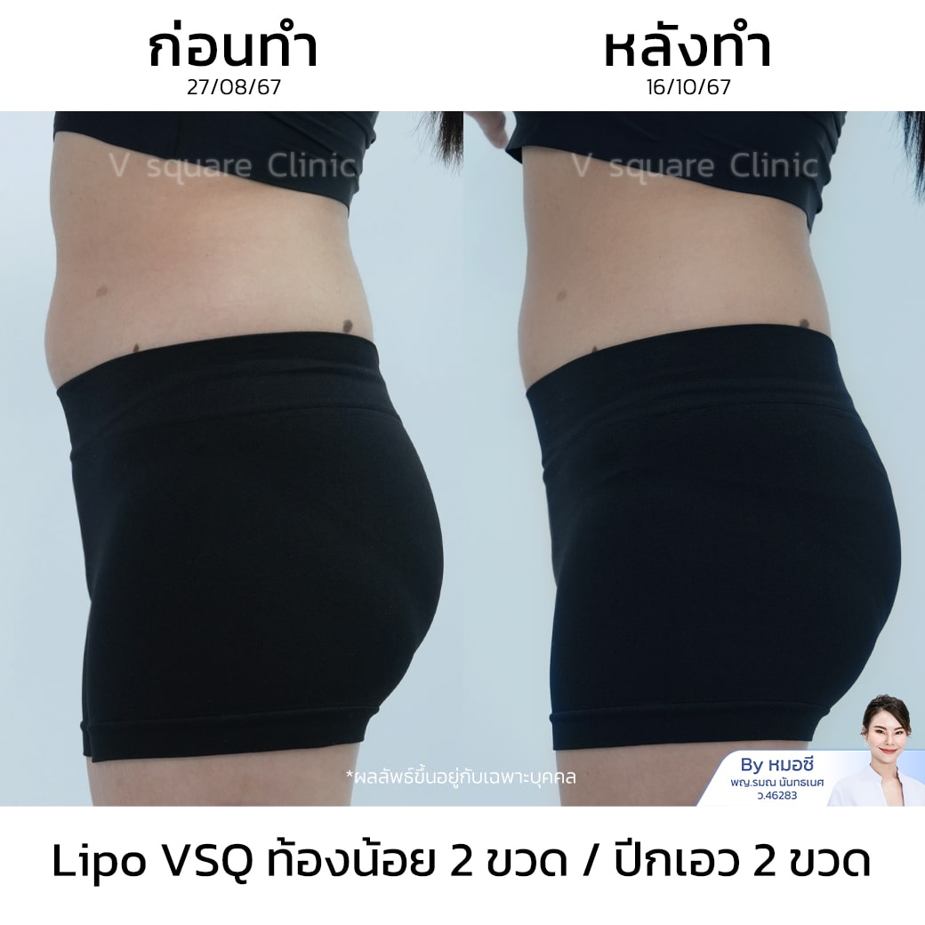 รีวิว Lipo VSQ