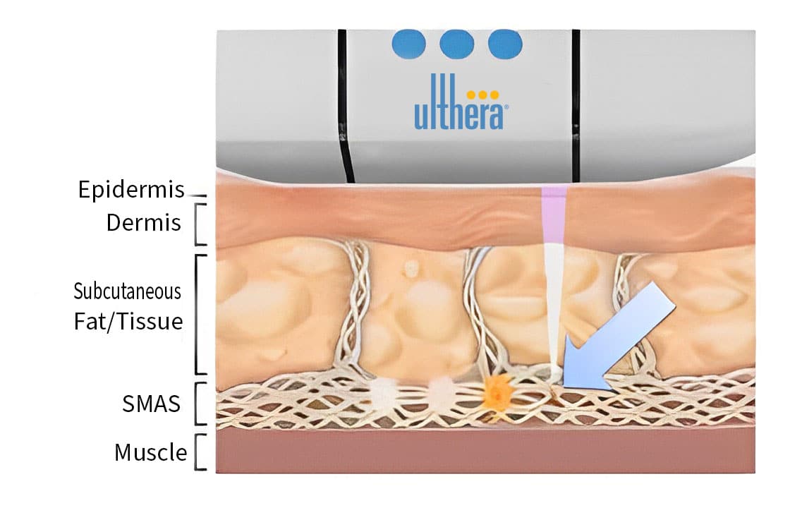 หลักการทำงานของ ulthera