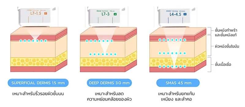 หัวยิงเครื่อง Ulthera